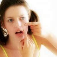 Control Acne Now! Don't Let Acne Control You!